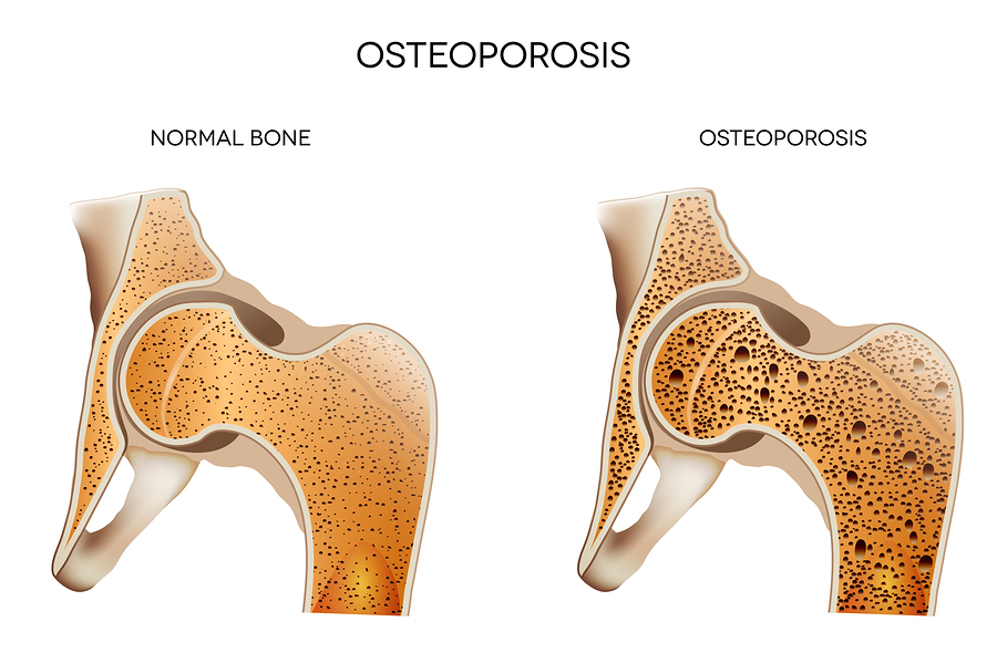 Home Care Pembroke Pines FL: Osteoporosis